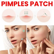 Jaysuing Star-Shaped Colored Acne Stickers | Fast-Acting Acne Treatment for Face