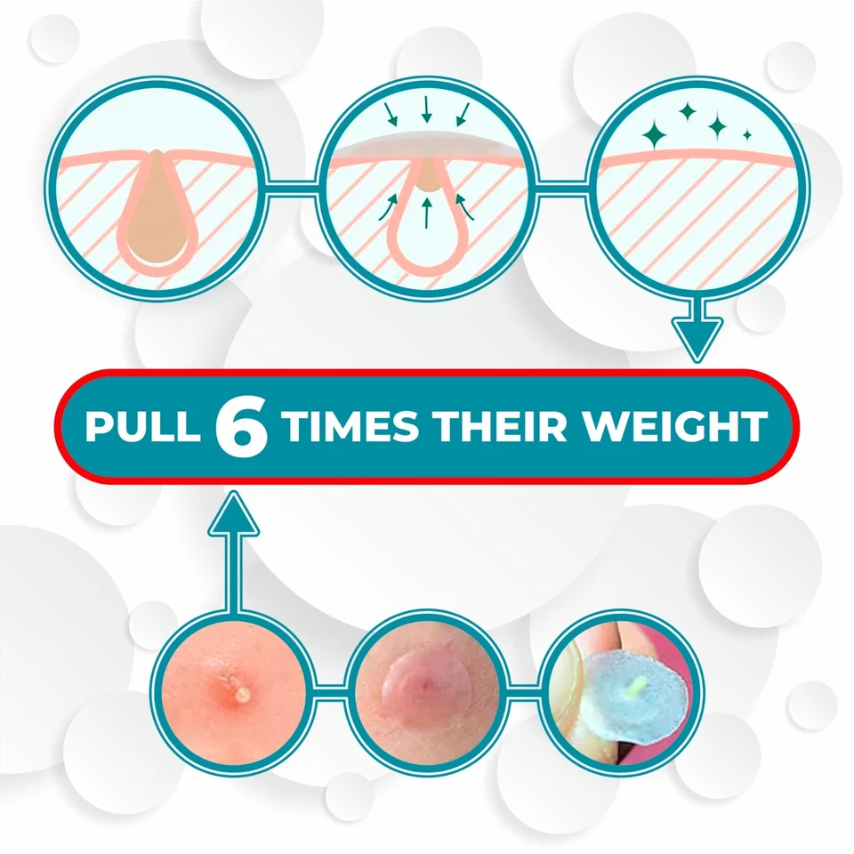 2x Parche para espinillas de acné (96 cuentas) hidrocoloide absorbente tamaño 2 fácil uso Foto 4 de 4