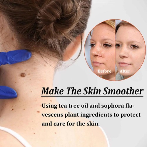 Wart Remover Serum Fast Safe Natural Treatment Skin C3J2 30ml Tags G7I7 Y8E2 - Picture 12 of 15