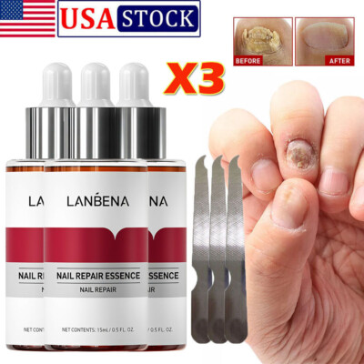3x LANBENA Nail Repair Essence Remove Onychomycosis Serum Fungal Nail Treatment