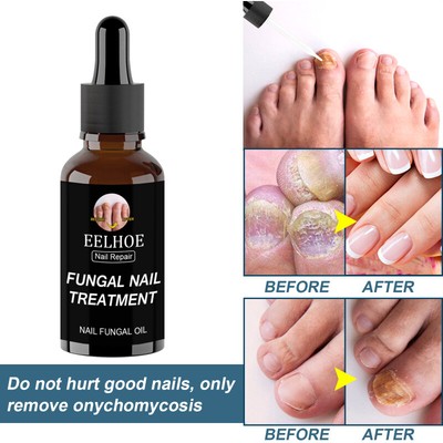 Nails Treatment Fungal Nail Antifungal Anti Fungus Toe Repair Cream Nail Care Ebay