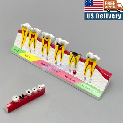 Dental Caries Disease Case Dentoform Typodont Study Demo Teaching Teeth Model
