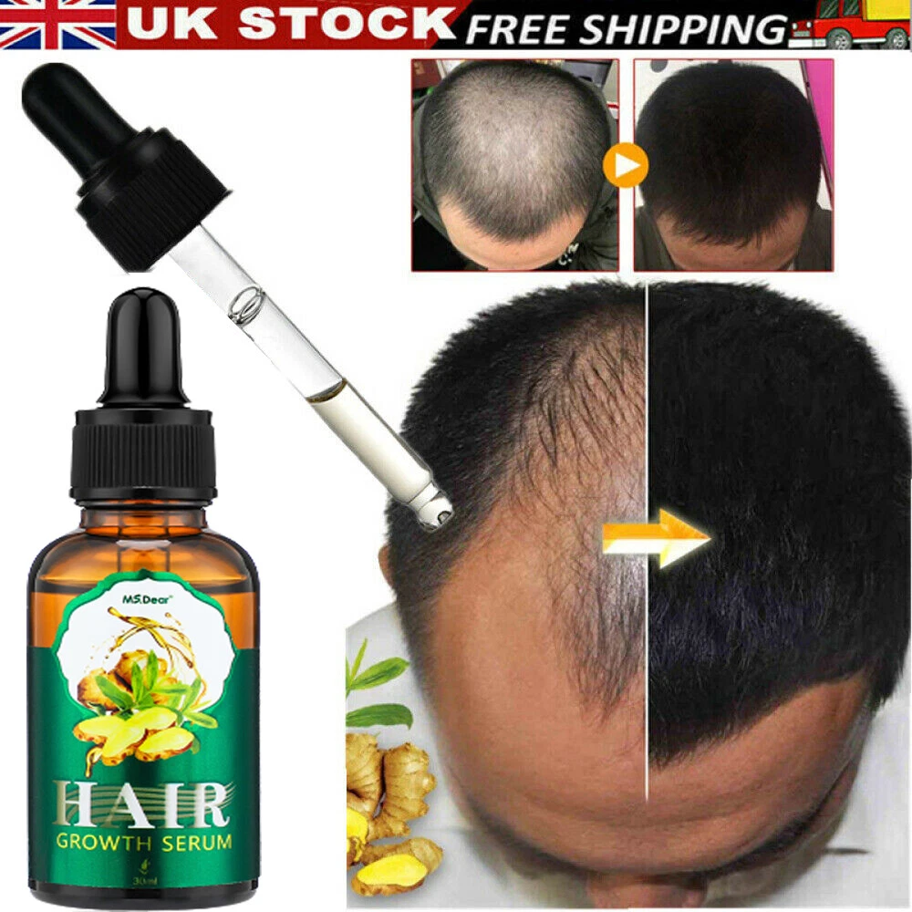 Update more than 142 ginger hair regrowth success stories best camera