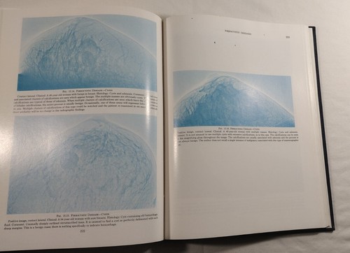 ATLAS OF MAMMOGRAPHY 1982 Hardcover Medical Book Radiology By John E Martin Vtg - Picture 12 of 20