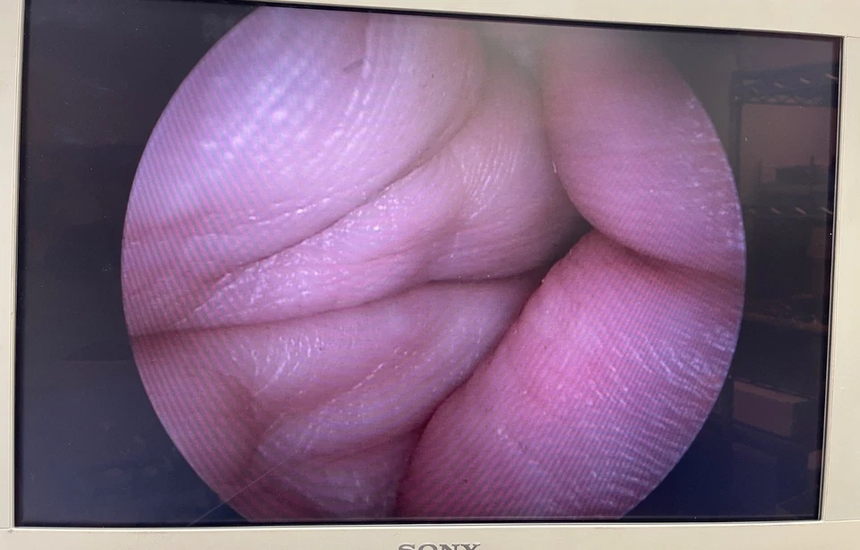 Laparoscopio autoclavable Karl Storz 26046AA 5mm x 0° x 29cm Hopkins II Foto 2 de 4