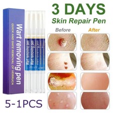 1-5Pcs Wart Remover Pen Skin Tag Mole Remover Eliminate Foot Corn Warts Unisex