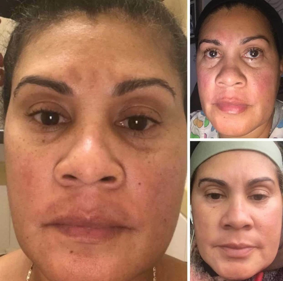 WHITE FADE SUPER SKIN LIGHTENER; PARA REMOVER MANCHAS OSCURAS DE LA PIEL, 2oz - Image 3 of 4