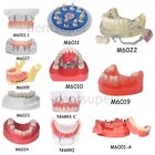 <!--F#f_0-->Dental Crown Restoration Model Demonstration With Partial Denture Tooth Mold Cov<!--F/-->