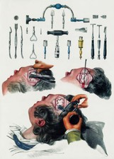 ML22 Vintage 1800's Medical Trepanning Trephining Surgical Poster RePrint A2/A3