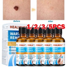 Wart Remover Liquid Skin Tag Mole Remover Eliminate Foot Corn Warts Unisex 30ML