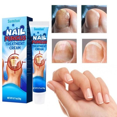 #Nail Treatment Fungus Fungal Anti toe Removal Cream CareInfection Solution DE .