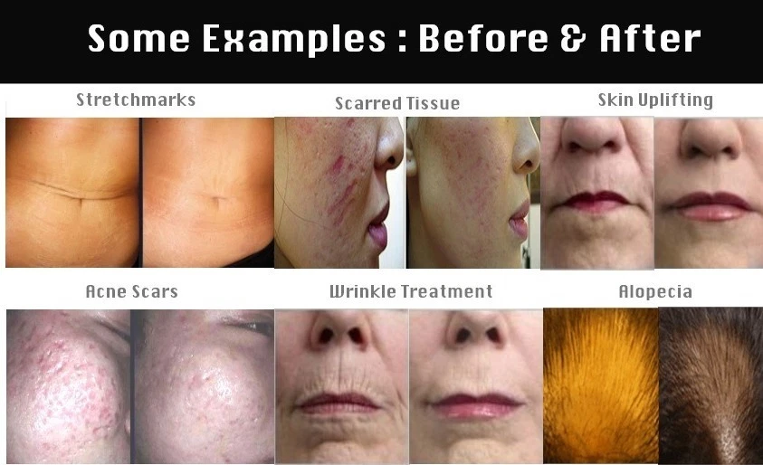 Derma Micro Needle Roller Titanium Diamond 540 Needles-Wrinkles, Acne,Pores MT - Image 4 of 4