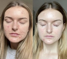 Cream for acne and wrinkles