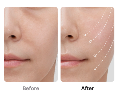 Medicube AGE-R Ultra Tune 40.68 Anti-Ageing Lifting Device