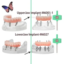 US Dental Upper/Lower 4 Implants Demo Teeth Model - Restoration Overdenture