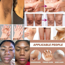 Dark Skin knuckle Whitening lightening Kojic acid Brightening CREAM 15g Unisex