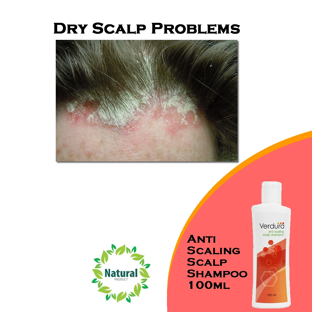 Flaky scalp shampoo online