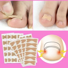 4PC/sheet Ingrown ToeNail Correction Patch Reduce Pain Recover Corrector Sticker