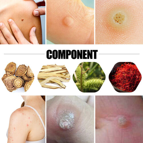 Foot Corn Removal Medical Plaster Foot Pad Patch Dead Skin Callus Remover Relief - Picture 4 of 10