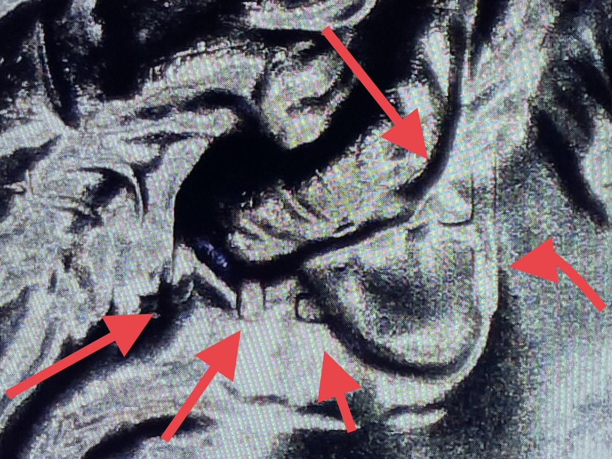 2023 P Edith Kanaka'ole Quarter BU “EDITH” Clashed Die Error | eBay