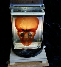 Complete Simple and Radical Mastoidectomy Lateral Sinus Issac H Jones MD 1955