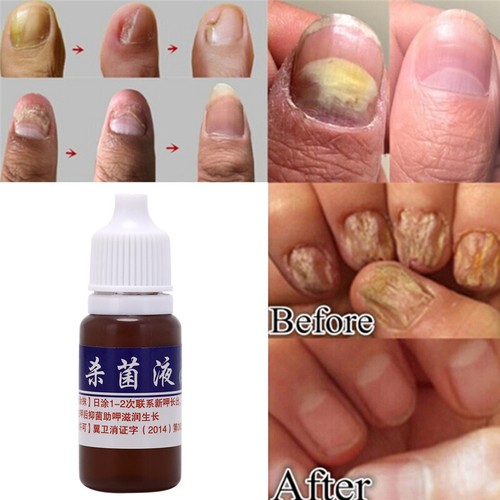 10ml Health Skin Care Nail Repair Treatment Liquid Cleanser