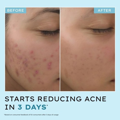 Hyphen Anti Acné 10% Ácido Azelaico 2% Ácido Salicílico Suero Facial Graso 30 ml - Imagen 3 de 8