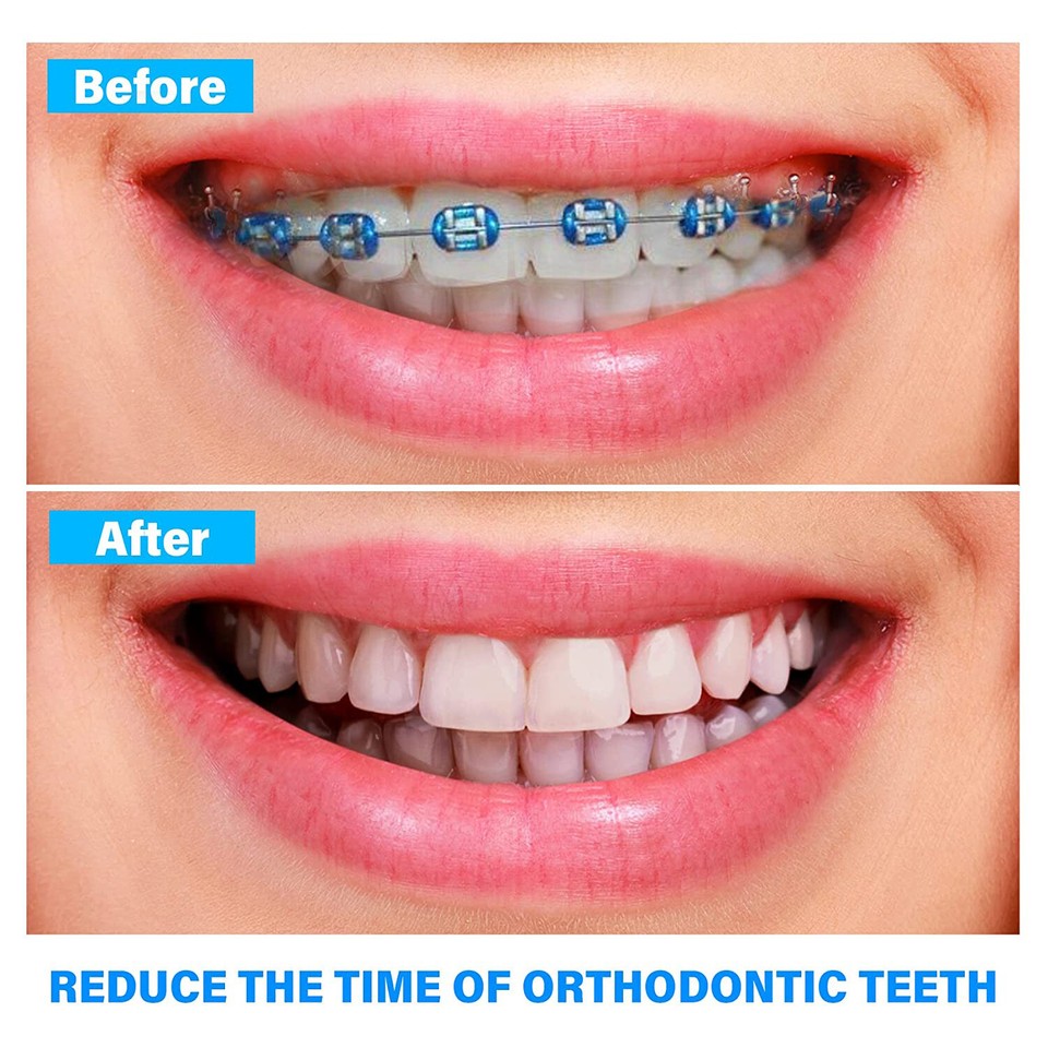 1040pcs Dental Orthodontic Ligature Ties Braces Elastic Rubber Bands