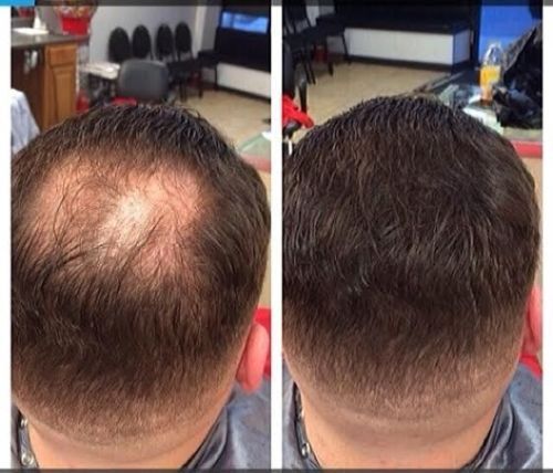 5x Hair Thickening Fibers by HAIR ILLUSION Bald Thinning Scalp Concealer Fiber - Picture 10 of 10