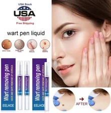 2× Wart Remover Pen Eliminate Skin Tag Foot Corn Mole Warts Restoration Painless