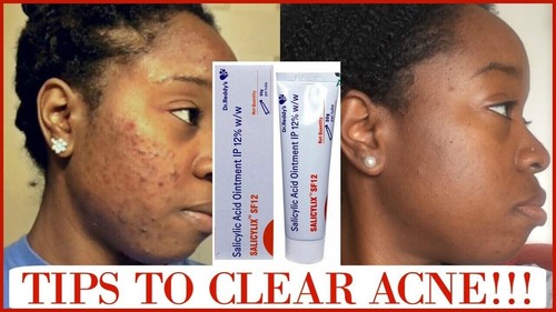 Salicylic Acid SF 12 Ointment 50gm for Psoriasis Eczema Acne Red Spots Treatment - Picture 2 of 5