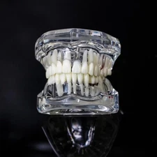 Dental Model Teeth Implant Restoration Bridge Teaching Study Dentist Dentistry