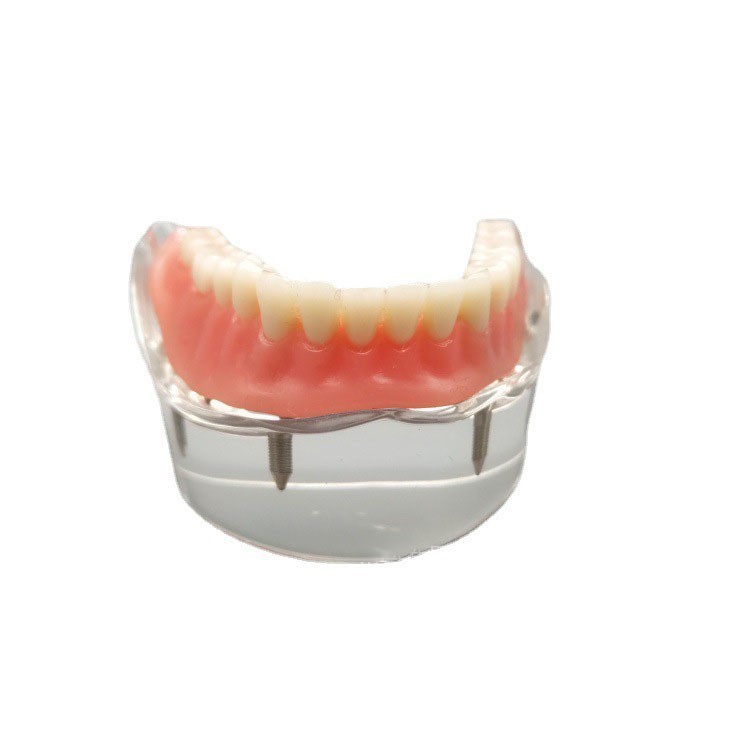 Dental Implant Teeth Model Demo Overdenture Restoration With