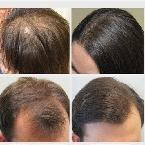 UNA Oxygenating Treatment 90 ml HAIR LOSS GROWTH NEW ORIGINAL - Picture 2 of 2