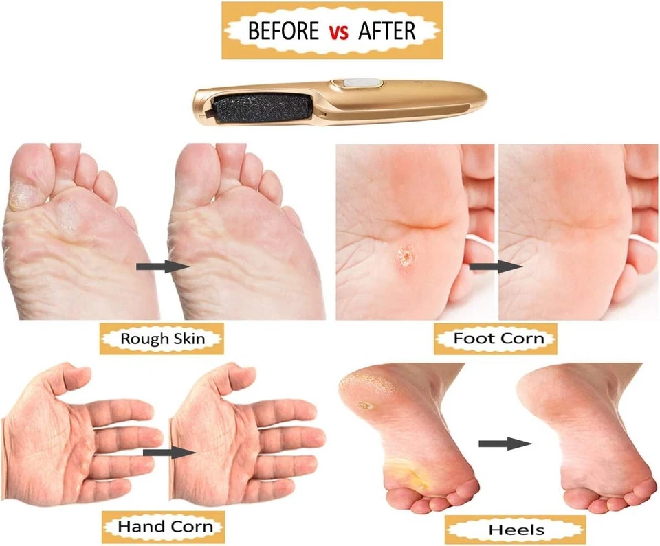 Powerful Electric Callus Remover Wand – Rechargeable Foot File, Grinder - Image 4 of 4