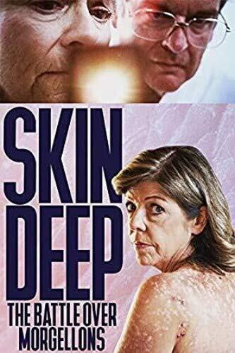 Skin Deep: The Battle Over Morgellons (DVD) Cindy Casey Steven R Feldman