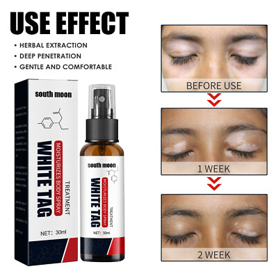 White Tag Treatment Moisturizing Spray Reduces White Spots Care Spray 30ml  | eBay