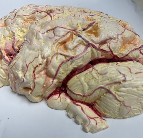 Vintage Brain Anatomical Pathology Model Demonstrating Meningitis - Picture 3 of 3