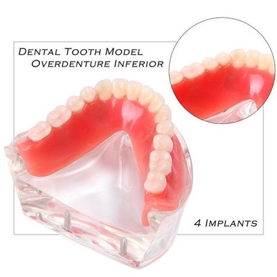 Dental Model Study Teach Overdenture Inferior With 4 Implant Demo Lower 6002 02