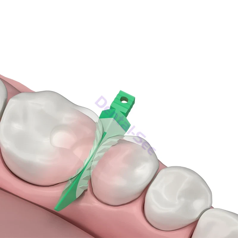Cuñas de estratos de cuña compuesta endo dental sello cervical suave matriz de diastema Foto 3 de 4