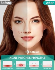 Pimple Patches for Face, 4 Size 150 Counts Acne Patches, Hydrocolloid Patches...
