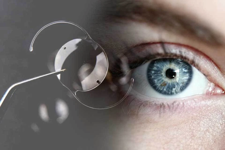 Lentes Intraoculares Intraocular Lens. Cataratas