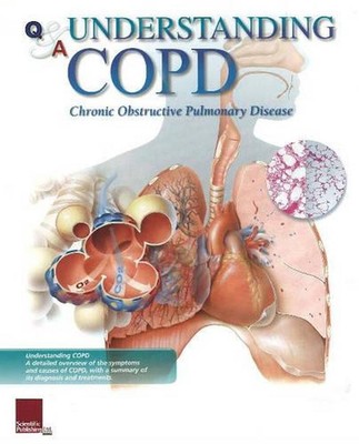 Understanding COPD Flip Chart: Flip Chart Book by Scientific Publishing (English