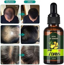 Aceite germinal de jengibre de crecimiento capilar 7 días para cabello más grueso y fuerte 30 ml