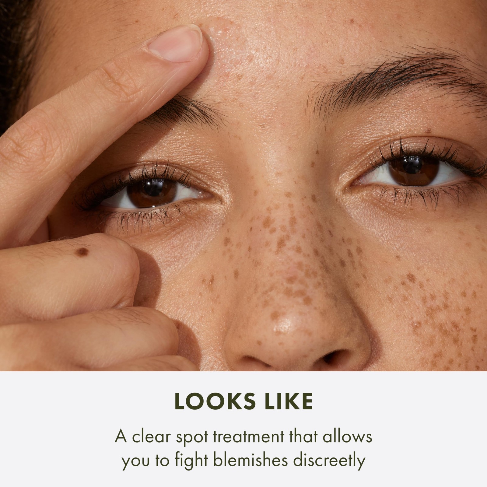 Super Spot Treatment for Acne | Treats & Prevents Acne Blemishes | With Salic...