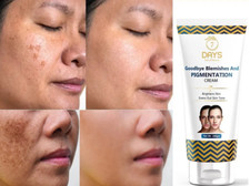 7 DAYS goodbye blemishes  Pigmentation dark Spots Removal Face Cream 100g