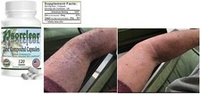 Psoriasis And Eczema Skin Relief, Proven Effective and All Natural Product