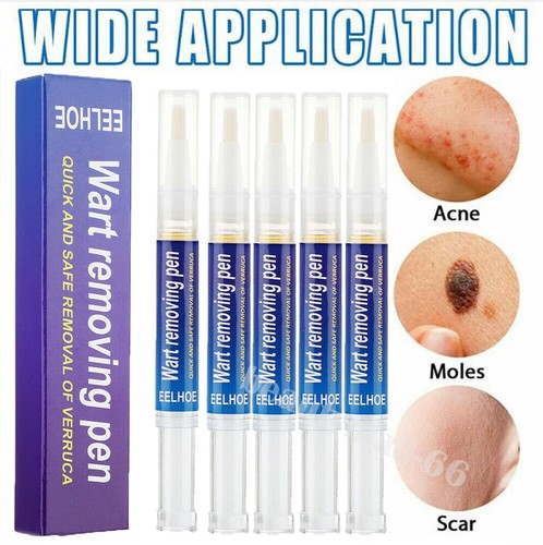 12 Hours Wart Remover Pen Skin Tag Mole Remover Eliminate Foot Corn Warts USA