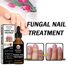 EELHOE Nail Repair Solution Thickening And Shining Nail Removal Dead Skin Repair