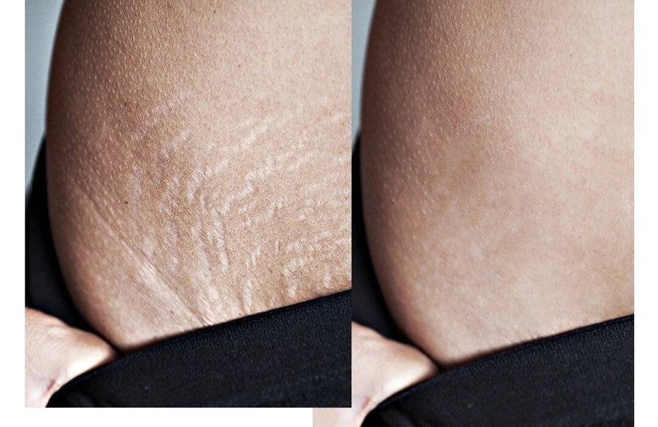 stretch mark cream - Image 4 of 4